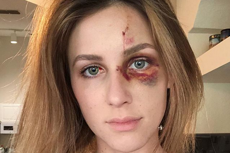 Violences conjugales : elle affiche son visage marqué de coups sur Instagram
