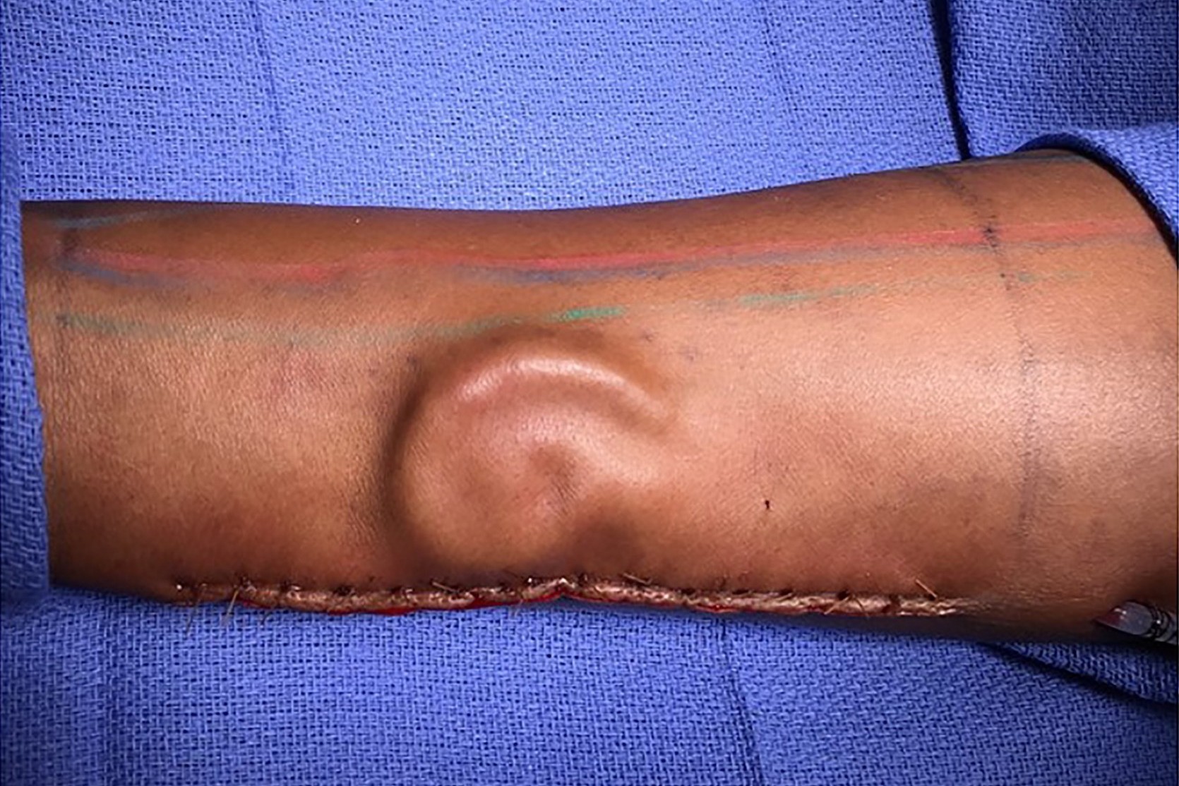 Etats Unis Une Militaire Greffee D Une Oreille Cultivee Dans Son Bras