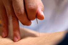 Illustration d'un docteur pratiquant l'acupuncture
