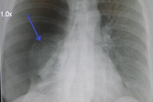 Image d'un important pneumothorax spontané droit