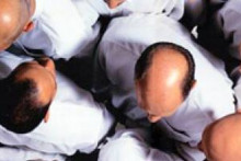 Calvitie (illustration)