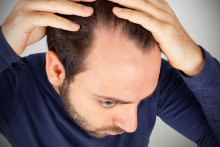 Un homme qui perd ses cheveux (photo d'illustration).