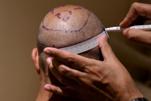 Une greffe de cheveux (illustration).