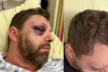 Le visage tuméfié de Pierre Picavet, après son agression.