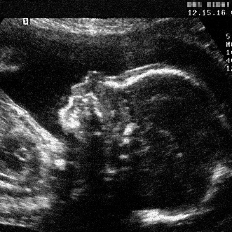 Italie : des microplastiques trouvés dans les placentas de femmes enceintes